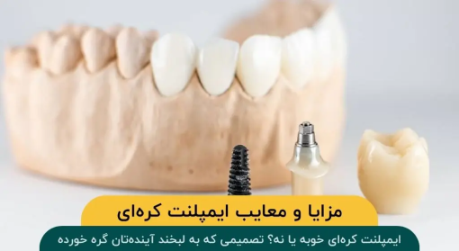 مزایا-معایب-ایمپلنت-کره‌-ای